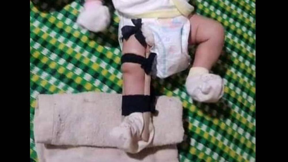 Bình Phước: Bé gái 2 tháng tuổi bị cha đánh gãy chân