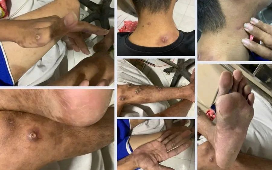 Đồng Nai ghi nhận ca bệnh đậu mùa khỉ chưa rõ nguồn lây